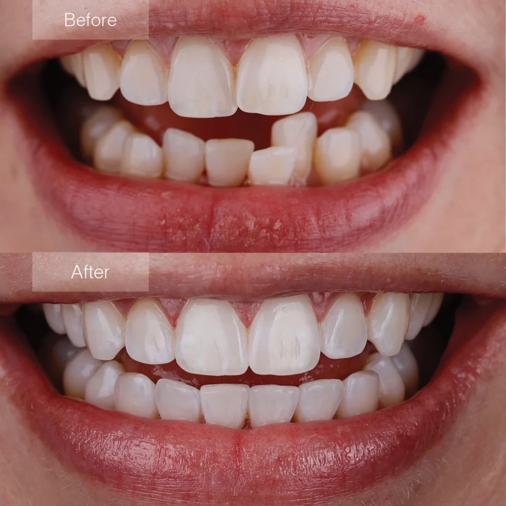 before and after clear aligners to straighten teeth